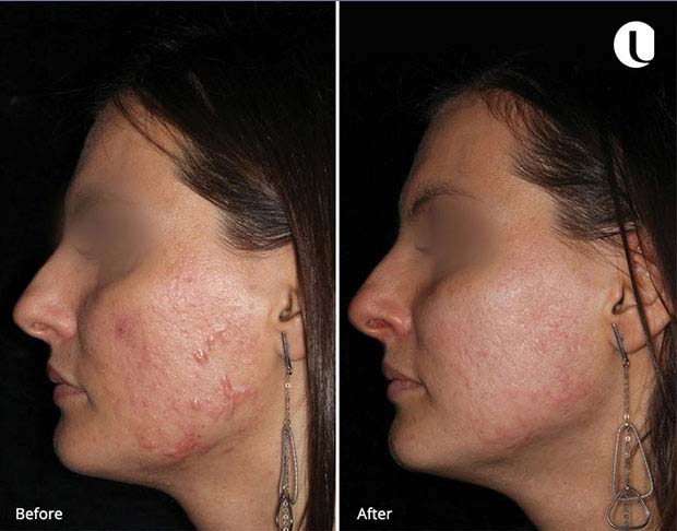 Acne Treatment Acne Treatment