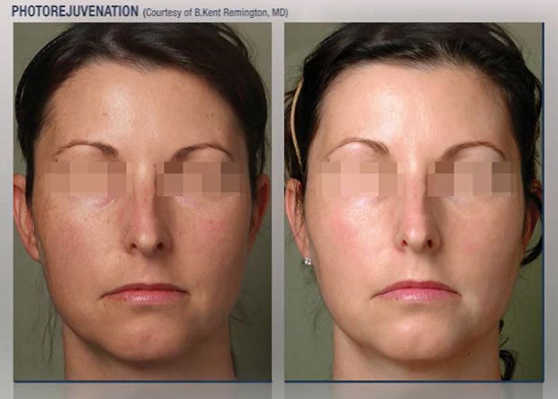 How many treatments do I need? How many treatments do I need?