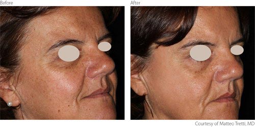 What is IPL Photofacial?