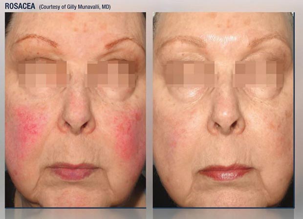 Rosacea Treatment in Lake Zurich, IL Rosacea Treatment in Lake Zurich, IL