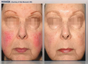 Rosacea Treatment in Lake Zurich, IL Rosacea Treatment in Lake Zurich, IL