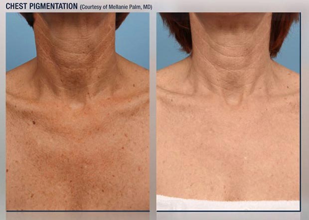 Skin Pigmentation Treatment in Lake Zurich, IL Skin Pigmentation Treatment in Lake Zurich, IL