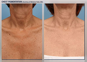 Skin Pigmentation Treatment in Lake Zurich, IL