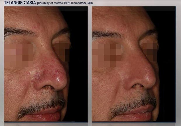 Capillaries Treatment in Lake Zurich, IL Capillaries Treatment in Lake Zurich, IL