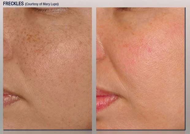 Removal of Age Spots, Freckles, Tattoos and Hair Removal