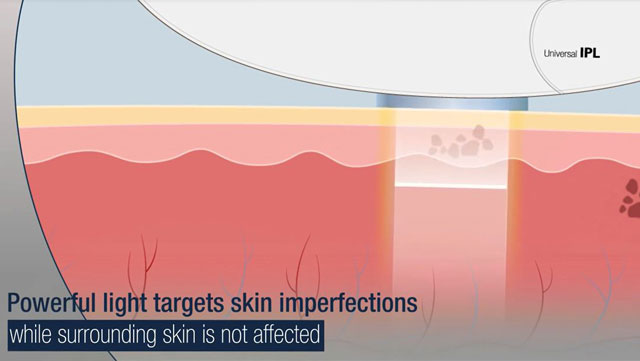 IPL Photofacial/Photorejuvenation Near Me in Lake Zurich, IL IPL Photofacial/Photorejuvenation Near Me in Lake Zurich, IL