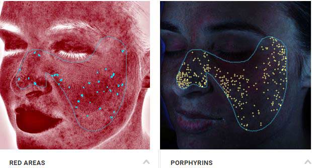 VISIA Complexion Skin Analysis