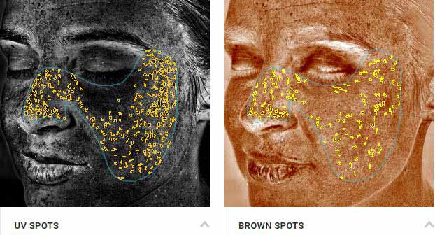 VISIA Complexion Skin Analysis