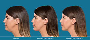 Kybella treatment