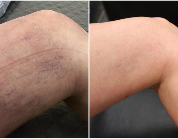Spider Veins and Leg Veins Treatment Spider Veins and Leg Veins Treatment