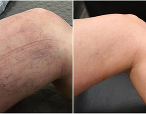 Spider Veins and Leg Veins Treatment Spider Veins and Leg Veins Treatment