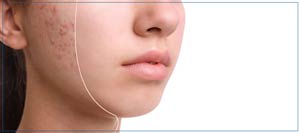 Acne Facial Specialist Near Me in Lake Zurich, IL 