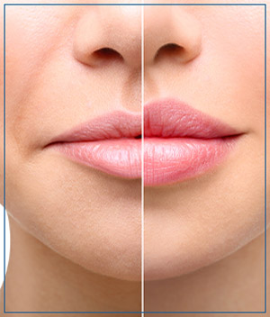 Dermal Fillers at Cara Mia Med Spa in Lake Zurich, IL