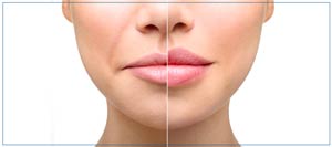 Dermal Fillers Specialist Near Me in Lake Zurich IL