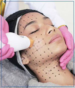 Thermage Treatment at Cara Mia Med Spa in Lake Zurich, IL