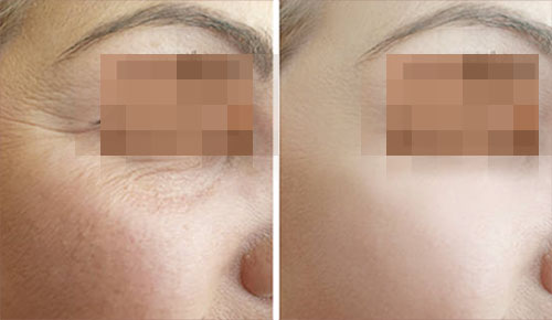 Botox/Jeuveau Treatment Before and After Photos at Cara Mia Medspa in Lake Zurich, IL Botox/Jeuveau Treatment Before and After Photos at Cara Mia Medspa in Lake Zurich, IL