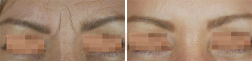 Botox/Jeuveau - Glabella