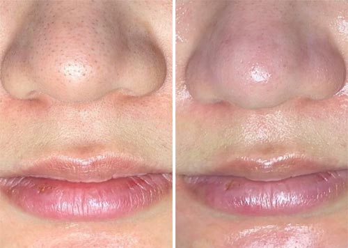 Hydrafacial MD Treatment Before and After Photos at Cara Mia Medspa in Lake Zurich, IL Hydrafacial MD Treatment Before and After Photos at Cara Mia Medspa in Lake Zurich, IL