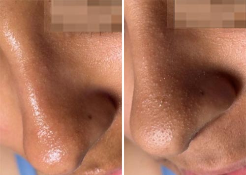 Hydrafacial MD Treatment Before and After Photos at Cara Mia Medspa in Lake Zurich, IL Hydrafacial MD Treatment Before and After Photos at Cara Mia Medspa in Lake Zurich, IL