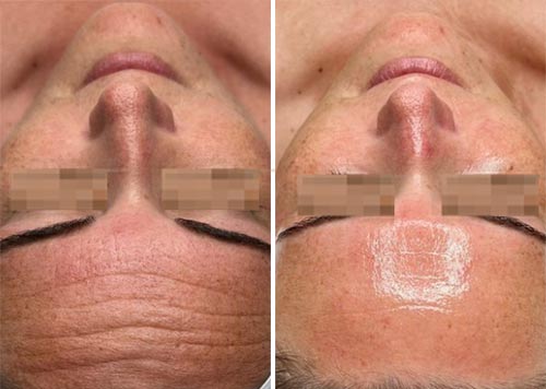 Hydrafacial MD Treatment Before and After Photos at Cara Mia Medspa in Lake Zurich, IL Hydrafacial MD Treatment Before and After Photos at Cara Mia Medspa in Lake Zurich, IL