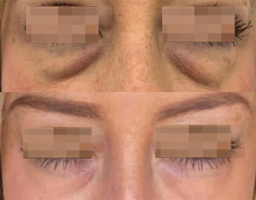 Plasma Pen MD Treatment Before and After Photos at Cara Mia Medspa in Lake Zurich, IL Plasma Pen MD Treatment Before and After Photos at Cara Mia Medspa in Lake Zurich, IL