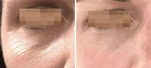 Plasma Pen MD Treatment Before and After Photos at Cara Mia Medspa in Lake Zurich, IL Plasma Pen MD Treatment Before and After Photos at Cara Mia Medspa in Lake Zurich, IL