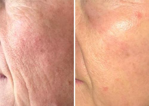 Plasma Pen MD Treatment Before and After Photos at Cara Mia Medspa in Lake Zurich, IL Plasma Pen MD Treatment Before and After Photos at Cara Mia Medspa in Lake Zurich, IL