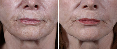 Plasma Pen MD Treatment Before and After Photos at Cara Mia Medspa in Lake Zurich, IL Plasma Pen MD Treatment Before and After Photos at Cara Mia Medspa in Lake Zurich, IL