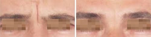 Botox/Jeuveau Treatment Before and After Photos at Cara Mia Medspa in Lake Zurich, IL Botox/Jeuveau Treatment Before and After Photos at Cara Mia Medspa in Lake Zurich, IL