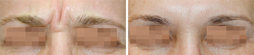 Botox/Jeuveau - Glabella