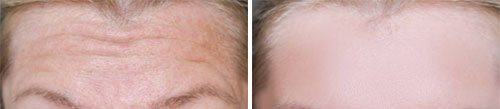 Botox/Jeuveau - Forehead Lines