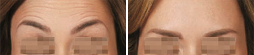 Botox/Jeuveau Treatment Before and After Photos at Cara Mia Medspa in Lake Zurich, IL Botox/Jeuveau Treatment Before and After Photos at Cara Mia Medspa in Lake Zurich, IL