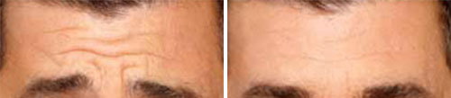 Botox/Jeuveau - Forehead Lines