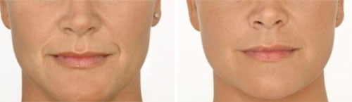 Dermal Fillers - Marionette Lines & Nasolabial Folds