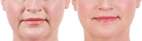 Dermal Fillers - Marionette Lines & Nasolabial Folds