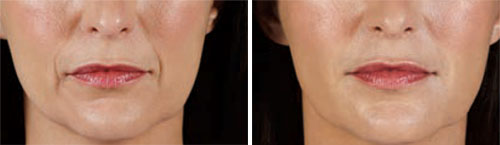 Dermal Fillers - Marionette Lines & Nasolabial Folds