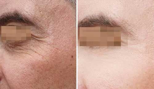 Botox/Jeuveau Treatment Before and After Photos at Cara Mia Medspa in Lake Zurich, IL Botox/Jeuveau Treatment Before and After Photos at Cara Mia Medspa in Lake Zurich, IL