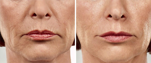 Dermal Fillers - Marionette Lines & Nasolabial Folds