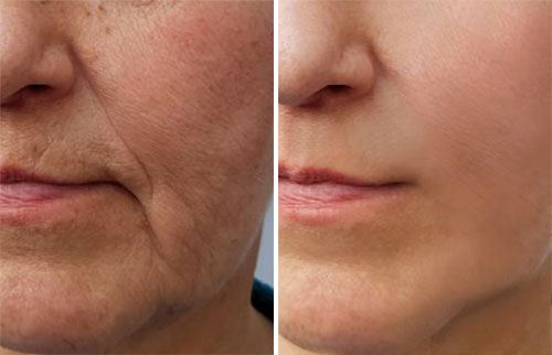 Dermal Fillers - Marionette Lines & Nasolabial Folds