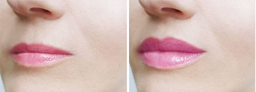 Lips Volbella Treatment Before and After Photos at Cara Mia Medspa in Lake Zurich, IL Lips Volbella Treatment Before and After Photos at Cara Mia Medspa in Lake Zurich, IL