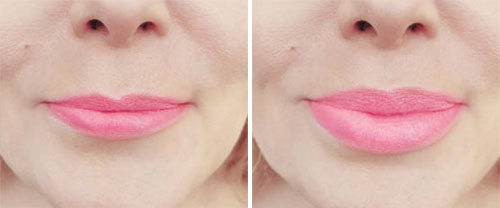 Lips Volbella Treatment Before and After Photos at Cara Mia Medspa in Lake Zurich, IL Lips Volbella Treatment Before and After Photos at Cara Mia Medspa in Lake Zurich, IL