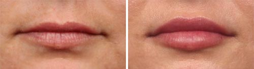 Lips Volbella Treatment Before and After Photos at Cara Mia Medspa in Lake Zurich, IL Lips Volbella Treatment Before and After Photos at Cara Mia Medspa in Lake Zurich, IL