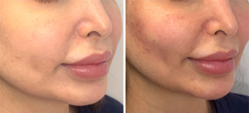 Cheeks Voluma Treatment Before and After Photos at Cara Mia Medspa in Lake Zurich, IL Cheeks Voluma Treatment Before and After Photos at Cara Mia Medspa in Lake Zurich, IL