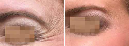 Botox/Jeuveau Treatment Before and After Photos at Cara Mia Medspa in Lake Zurich, IL Botox/Jeuveau Treatment Before and After Photos at Cara Mia Medspa in Lake Zurich, IL