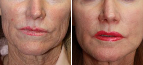 Cheeks Voluma Treatment Before and After Photos at Cara Mia Medspa in Lake Zurich, IL Cheeks Voluma Treatment Before and After Photos at Cara Mia Medspa in Lake Zurich, IL