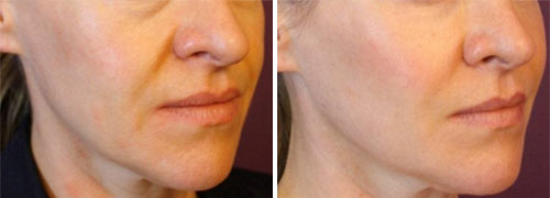 Cheeks Voluma Treatment Before and After Photos at Cara Mia Medspa in Lake Zurich, IL Cheeks Voluma Treatment Before and After Photos at Cara Mia Medspa in Lake Zurich, IL
