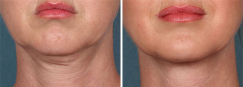 Kybella Treatment Before and After Photos at Cara Mia Medspa in Lake Zurich, IL Kybella Treatment Before and After Photos at Cara Mia Medspa in Lake Zurich, IL