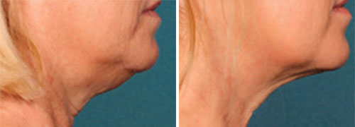 Kybella Treatment Before and After Photos at Cara Mia Medspa in Lake Zurich, IL Kybella Treatment Before and After Photos at Cara Mia Medspa in Lake Zurich, IL