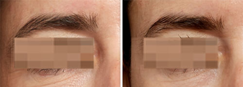 PRX-T33 Facial Before and After Photos at Cara Mia Medspa in Lake Zurich, IL PRX-T33 Facial Before and After Photos at Cara Mia Medspa in Lake Zurich, IL
