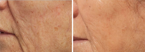 PRX-T33 Facial Before and After Photos at Cara Mia Medspa in Lake Zurich, IL PRX-T33 Facial Before and After Photos at Cara Mia Medspa in Lake Zurich, IL